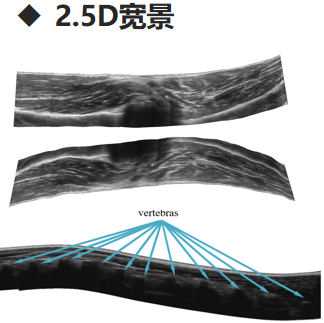 2.5D超声宽景重构
